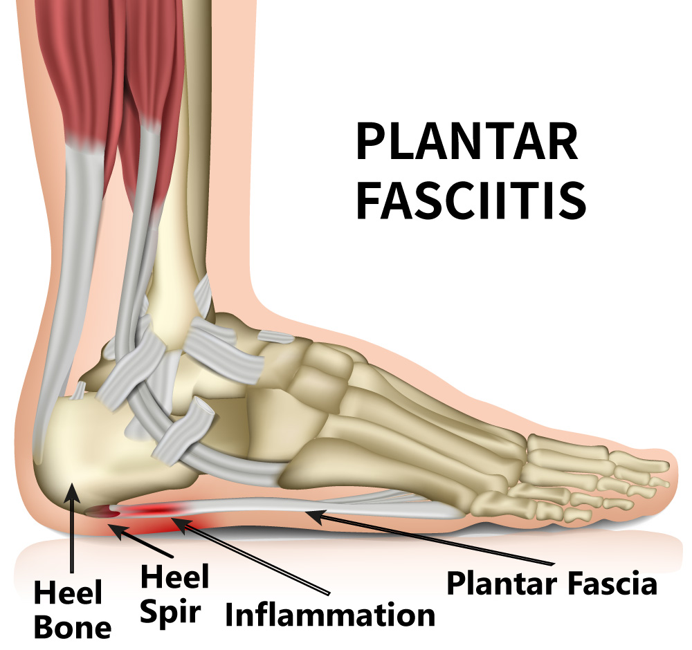 Plantar fasciitis - inflammation & heel spurs