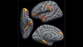 The red-yellow regions are the parts of the brain that shrank the most in the 401 SARS-CoV-2 (Covid-19) infected participants, compared with the 384 noninfected participants.