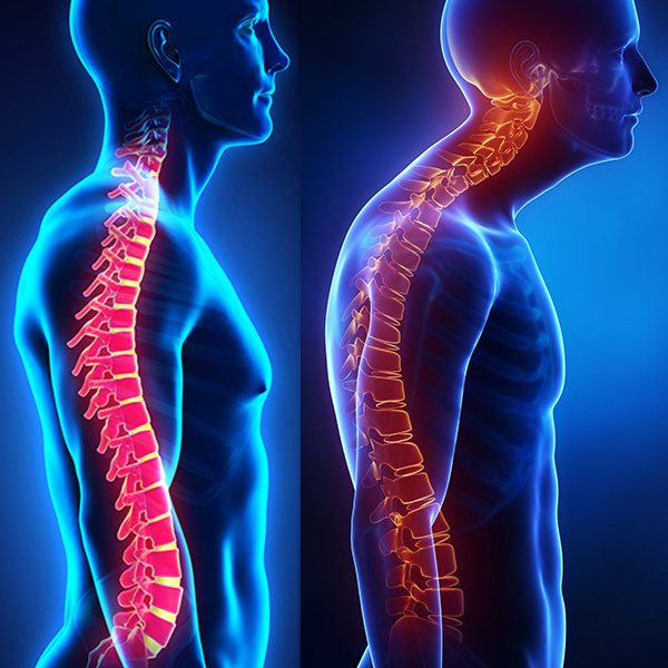 Western Medical Treatment options for Kyphosis (humpback).